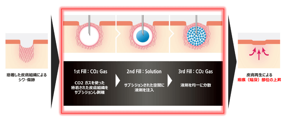 トライフィルプロとは