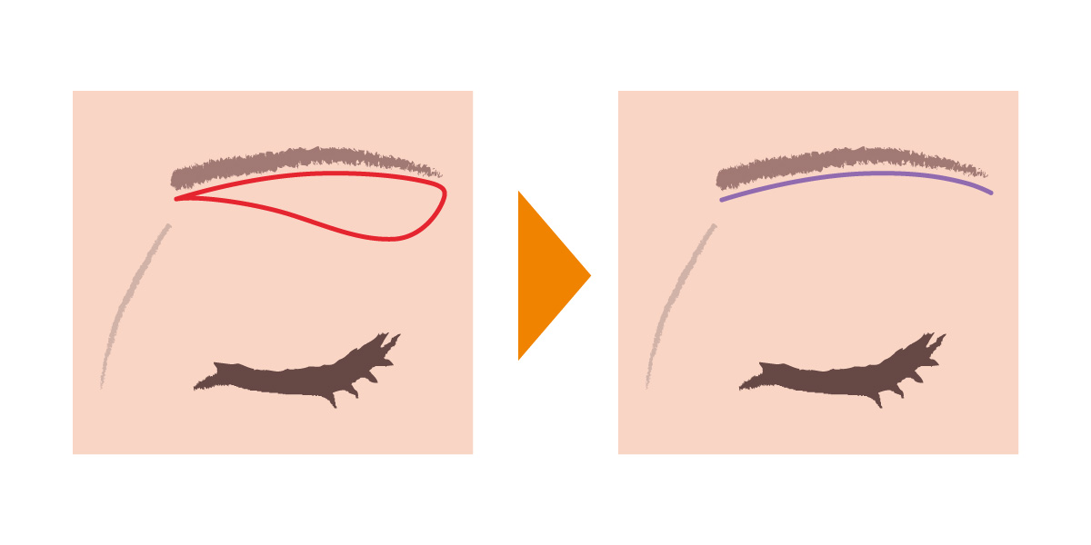 眉下皮膚切開法 - 余剰皮膚切除術