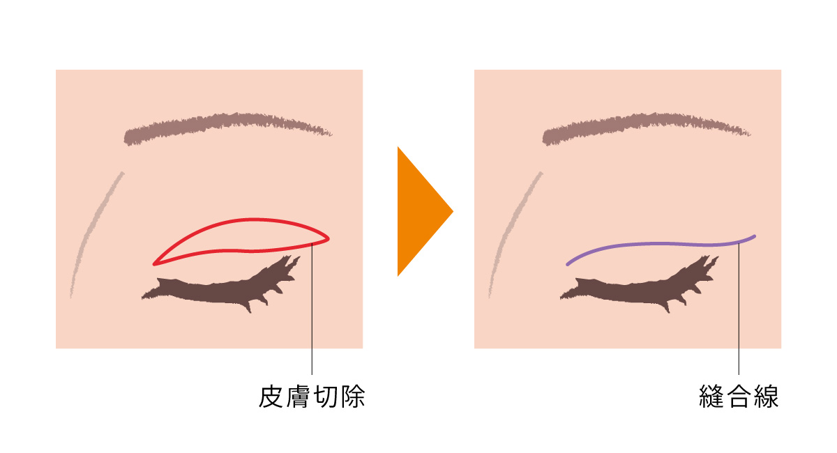 重瞼線皮膚切開法 - 余剰皮膚切除術